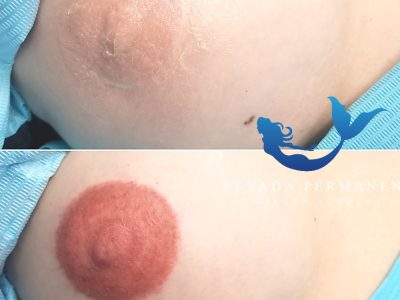 Breast Re-pigmentation Advanced Procedure